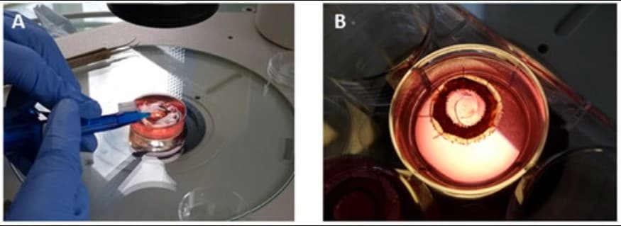 Researchers use 3D printing to improve treatment techniques for cataracts and other eye diseases